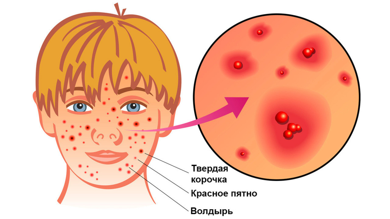 Профилактика ветряной оспы